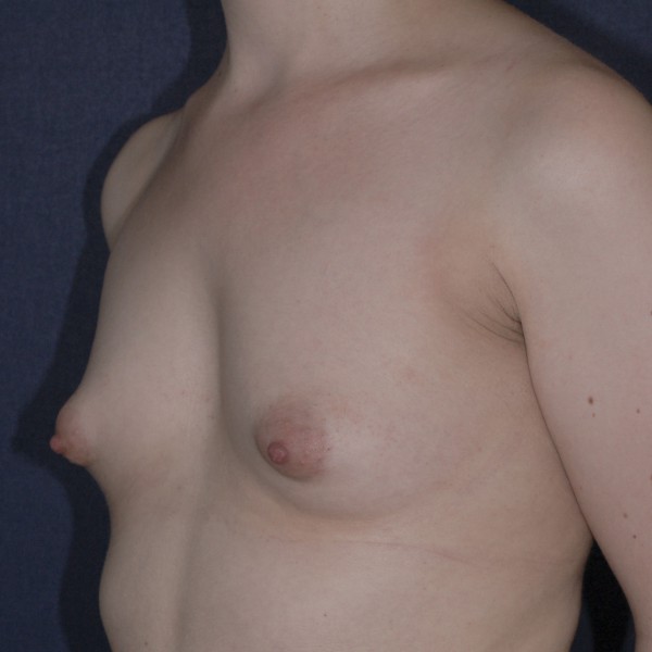 Tubular Breasts Pre-op
