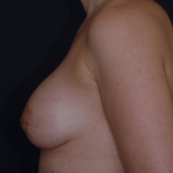 Mastopexy with implants Post-op